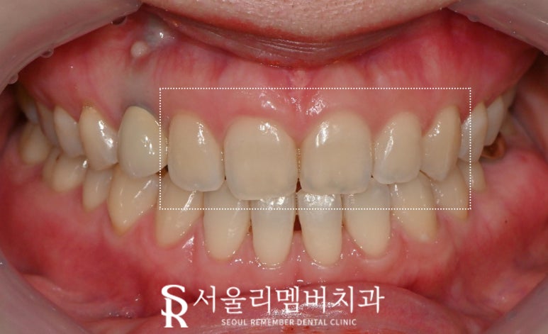 상도동 치과 "진짜(real, 리얼) 같은 자연스러움" 개인 맞춤형 무삭제 라미네이트 관련 이미지 2