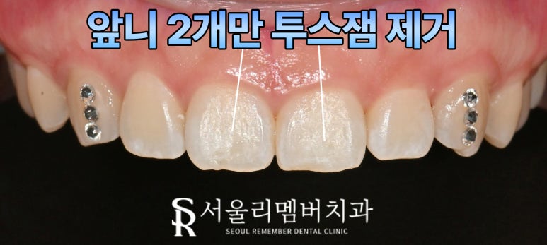 투스잼 제거, 전문가에게 맡겨야 하는 이유 신림역 치과 원하는 치아만 선택적으로 없앨 수 있을까? 관련 이미지 3