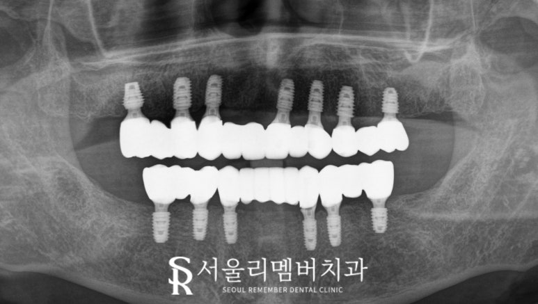 보라매 치과 에서 틀니에서 수면마취 전악 임플란트로 전체 치아 기능 회복 관련 이미지 5