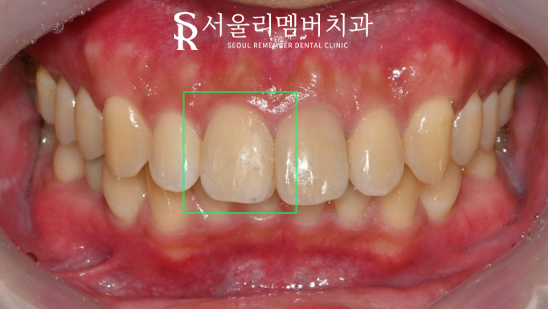 서울대입구 치과 앞니 절단연 파절 레진 당일 충전 진행 과정 및 관리법 관련 이미지 2