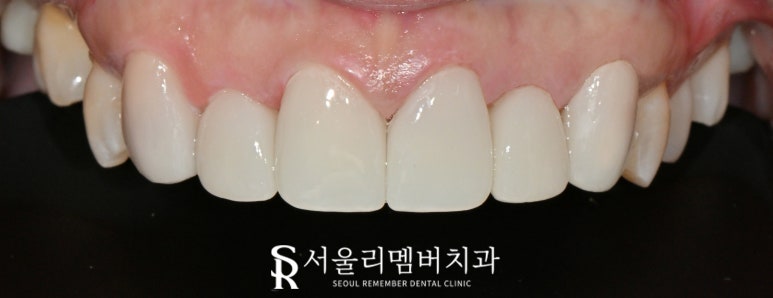 Nakseongdae Dental Clinic: If a front tooth laminate veneer falls off, can’t it just be reattached? Anterior crowns and Realnate re-prosthetics image 7