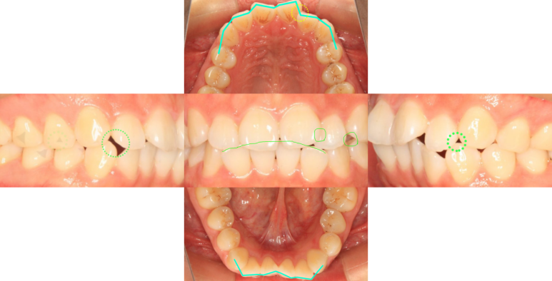 삐뚤어진 앞니 치료 전 관련 이미지 1