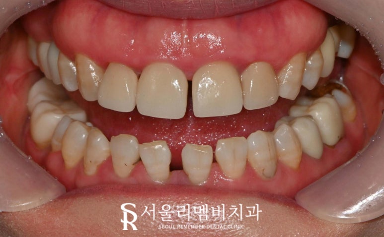 위아래 앞니 벌어짐으로 상하악 전치부 크라운 치료하는 과정은? 서울대입구 치과 관련 이미지 2