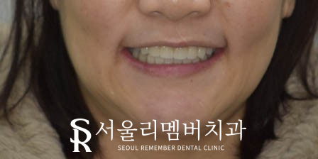 텅텅 여기저기 빠져버린 치아들, 이젠 음식을 씹을 수도 없어요.. 어떡하죠? 서울대입구역 리멤버 치과 관련 이미지 8