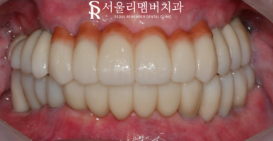 여러 곳이 결손된 치아 서울대입구역 치과 에서 다수 임플란트 식립으로 불편감을 개선해 드린 케이스 관련 이미지 7