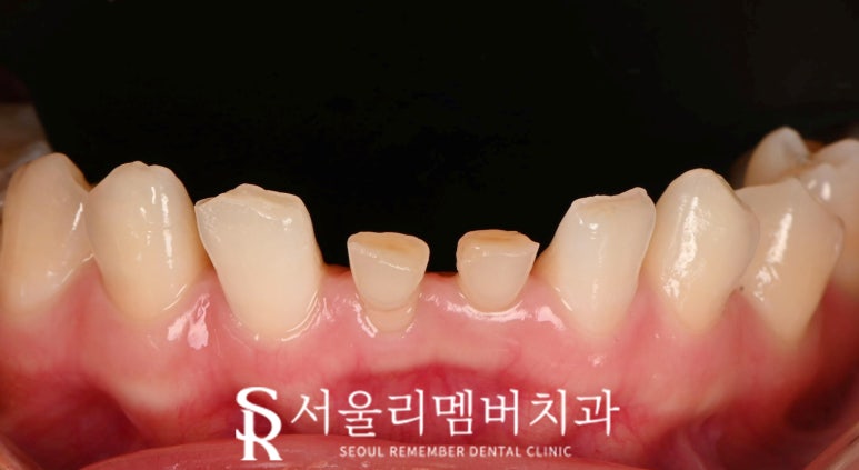 사당 치과 아래 앞니 만기 잔존 유치 크라운과 리얼네이트 동시에 심미 보철 치료 관련 이미지 4