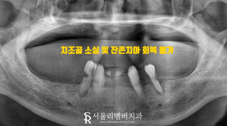오랜 틀니 착용으로 잇몸이 다 망가졌던 분.. 임플란트 식립으로 밝은 미소 되찾아드렸습니다! 서울대입구역 서울 리멤버 치과 관련 이미지 4