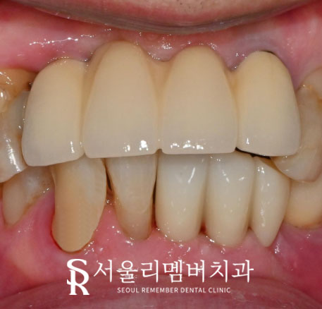 아래 앞니 임플란트 수명 얼마나 될까? 서울대입구역치과 에서 제대로 된 치료 받으세요. 관련 이미지 6