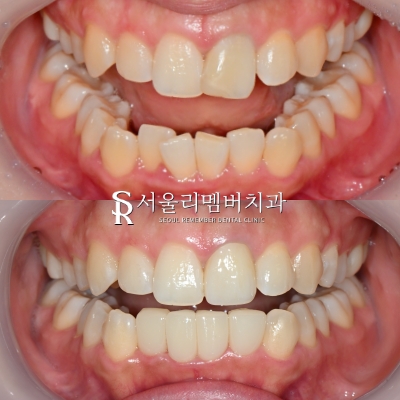 교정이 부담스러운데 치아 삐뚤빼뚤 총생 있다면 봉천역 치과 전치부 리얼네이트와 앞니 크라운 관련 이미지 3