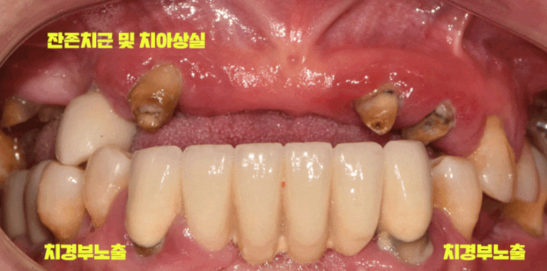 빠져버린 치아 그대로 내버려 두면 안모변형을 초래할 수 있습니다! 신림역 서울 리멤버 치과 관련 이미지 1