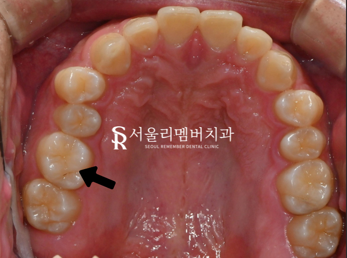 사당동 리멤버 치과 에서 어금니 이시림을 인레이로 개선해 드렸습니다. 관련 이미지 1
