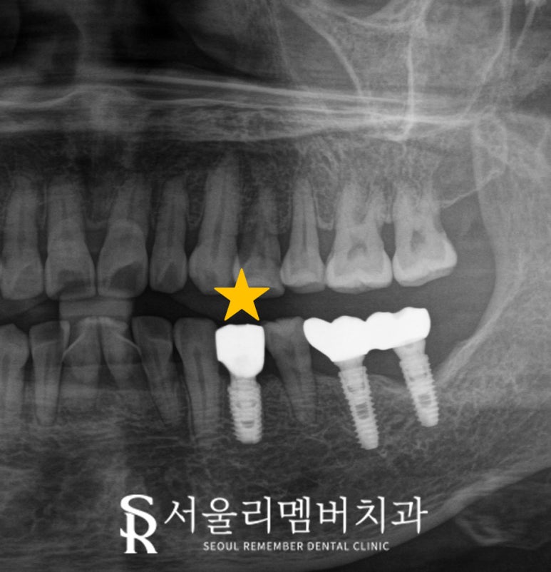 보라매 치과 신경치료 치아 부러짐, 당일 발치 즉시 임플란트 동시 식립(Simple case) 관련 이미지 4