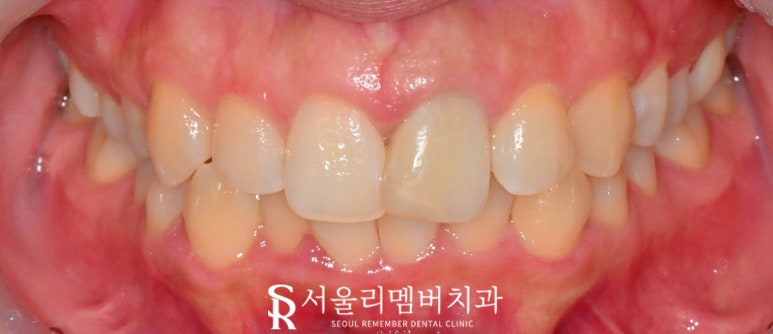 교정이 부담스러운데 치아 삐뚤빼뚤 총생 있다면 봉천역 치과 전치부 리얼네이트와 앞니 크라운 관련 이미지 1