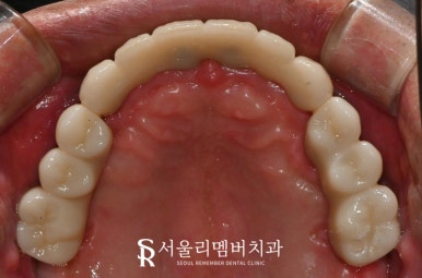 치아 빠지고 흔들리는 어금니와 치주 질환으로 통증 생긴 구강, 관악구 치과 상악 전체 임플란트 및 하악 신경치료 크라운 진행 과정 관련 이미지 7