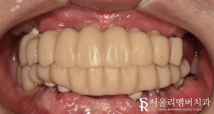 빠져버린 치아 그대로 내버려 두면 안모변형을 초래할 수 있습니다! 신림역 서울 리멤버 치과 관련 이미지 7