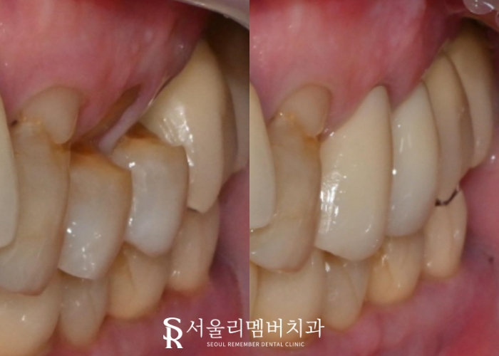 서울대입구역 치과 에서 작은 어금니 깊은 파임, 신경치료 후 통증 없는 크라운 진행 과정 알려드립니다. 관련 이미지 5