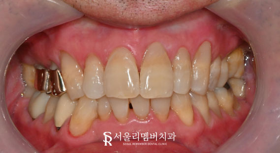 찌릿한 잇몸 패임, 서울대입구역치과 에서 티 안 나게 한 번에! 관련 이미지 2