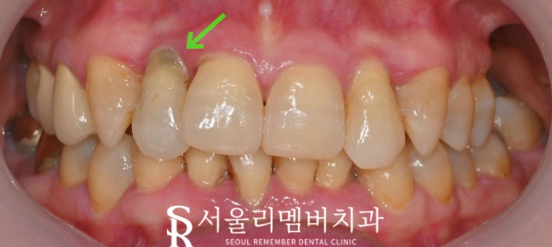 앞니 충치, 살릴 수 없는 상태라면? 서울대입구 임플란트 치과에서 해결 관련 이미지 2