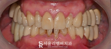 임플란트 및 크라운 으로 구강 환경 개선하는 방법 - 서울대입구역 치과 관련 이미지 8