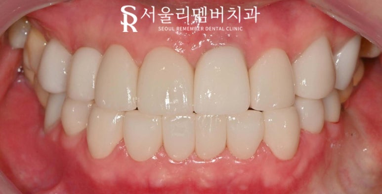 중년 치열 틀어짐 및 파절과 변색, 봉천동 치과 치아교정 대신 심미보철 치료 (임플란트 크라운 라미네이트 복합 증례) 관련 이미지 6