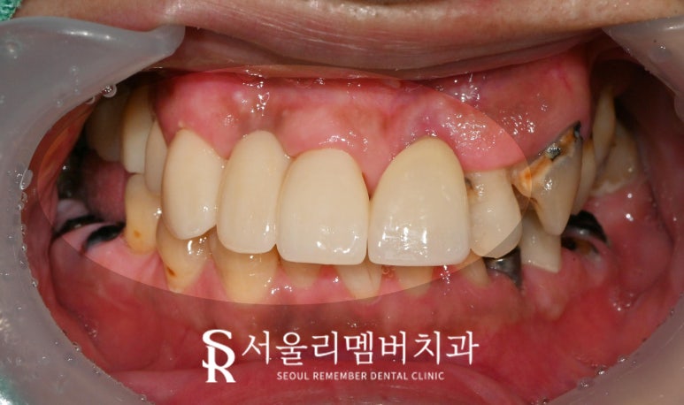 서울대입구역 치과 다발성 우식증 존재할 경우, 신경치료 후 브릿지 수복 과정 관련 이미지 3