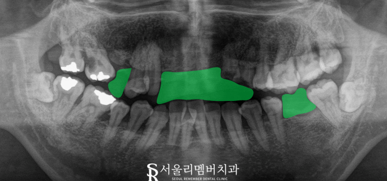 때늦은 치료, 임플란트와 크라운으로 바로잡는 서울대입구역 치과 관련 이미지 1