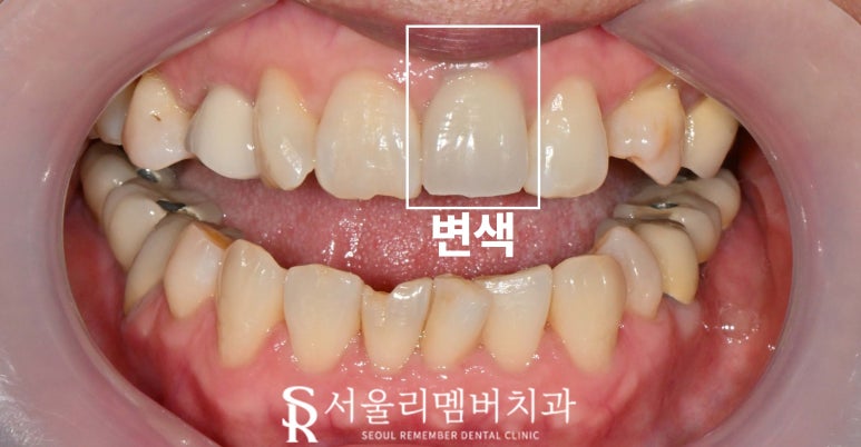 중년 치열 틀어짐 및 파절과 변색, 봉천동 치과 치아교정 대신 심미보철 치료 (임플란트 크라운 라미네이트 복합 증례) 관련 이미지 3