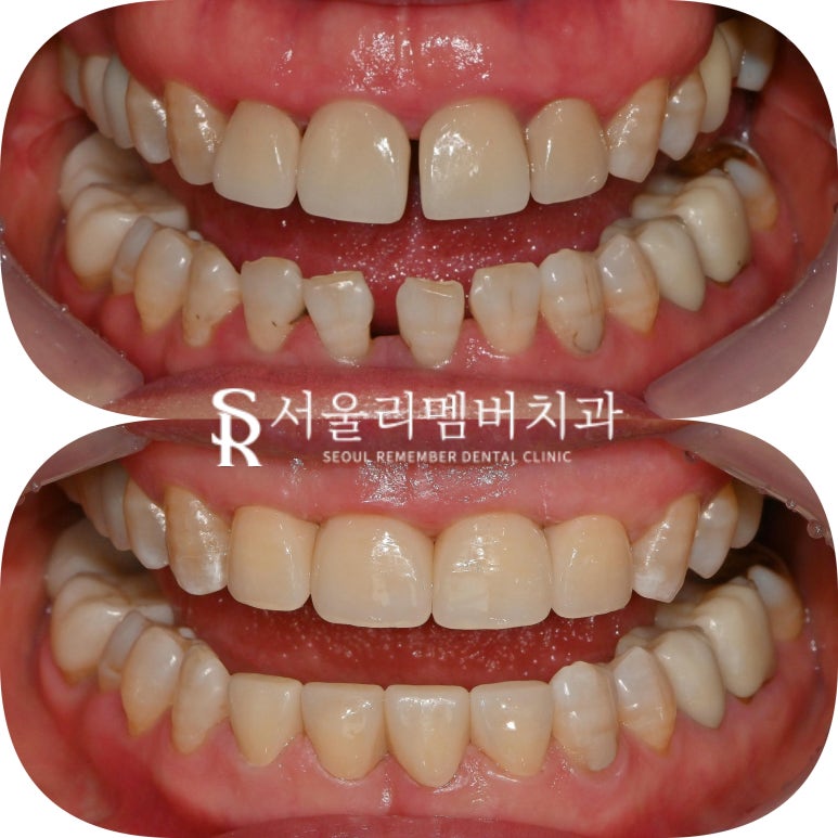 위아래 앞니 벌어짐으로 상하악 전치부 크라운 치료하는 과정은? 서울대입구 치과 관련 이미지 4