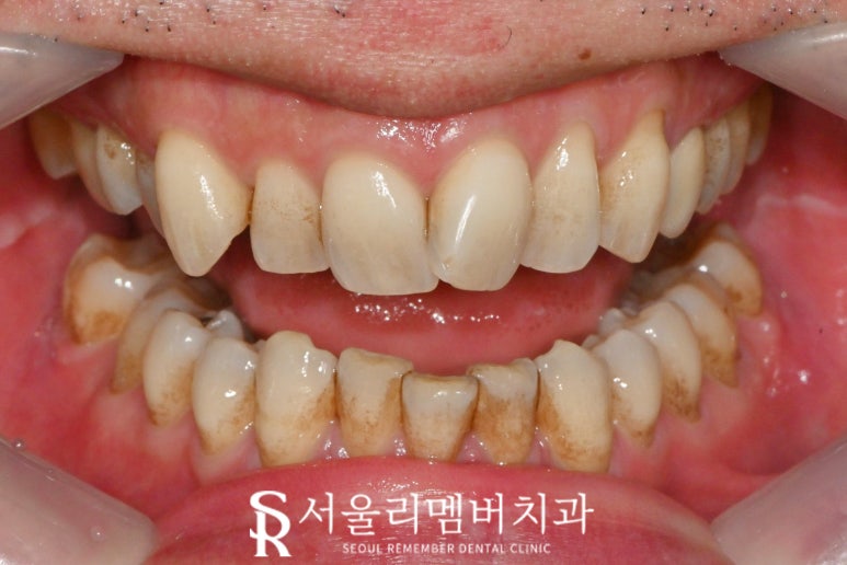 신림역 치과 스케일링 치석제거로 착색과 변색 해결하면 치아미백 만큼 하애질 수 있을까? 관련 이미지 1
