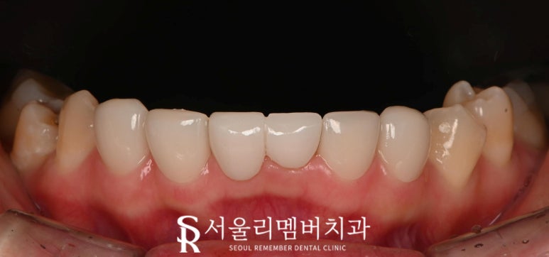 사당 치과 아래 앞니 만기 잔존 유치 크라운과 리얼네이트 동시에 심미 보철 치료 관련 이미지 8