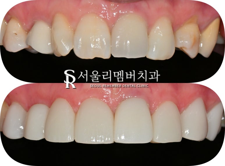 중년 치열 틀어짐 및 파절과 변색, 봉천동 치과 치아교정 대신 심미보철 치료 (임플란트 크라운 라미네이트 복합 증례) 관련 이미지 4