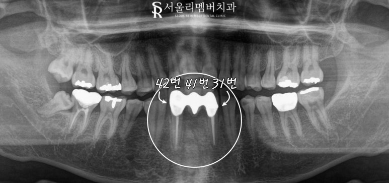 서울대입구 치과 아래 앞니 하악 전치부 브릿지에서 임플란트로 바꿀 수 있나요? 관련 이미지 1