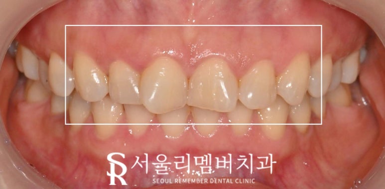 사당 치과 틀어지고 뻐드러진 앞니, 송곳니까지 리얼네이트 치료로 자연스러운 전치부 균형 찾기 관련 이미지 2
