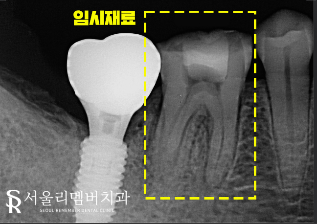낙성대역 치과 신경치료가 필요한 경우는?! 관련 이미지 5