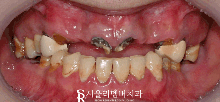 믿고 맡길 수 있는 신대방 치과 전체 임플란트 관련 이미지 5
