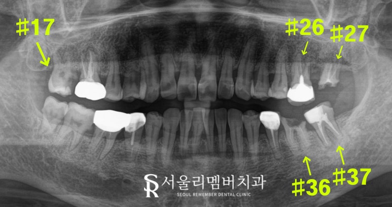 살리려던 어금니, 신경치료 시도 후 결국 임플란트로 복구한 보라매 치과 치료 사례 관련 이미지 1