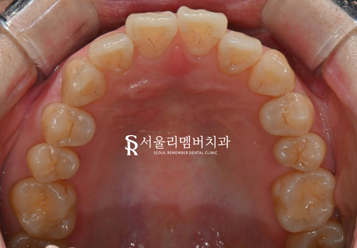 서울대입구역 치과 이렇게만 해도 치아 수명을 늘릴 수 있습니다 관련 이미지 4