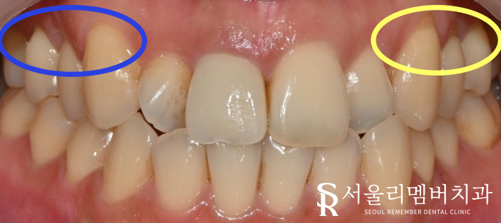봉천역 치과 에서 레진 당일 치료로 치경부마모증(CA)를 개선해드렸습니다. 관련 이미지 1