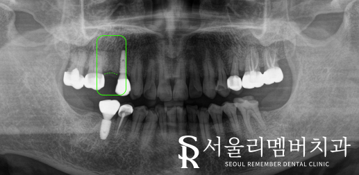 신길동 치과 임플란트에 대한 여러 소문들, 과연 사실일까? 관련 이미지 2