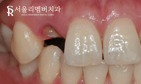 어? 전에 올려놨던 앞니 크라운이 갑자기 떨어졌어요 ! 신길동 치과 관련 이미지 6