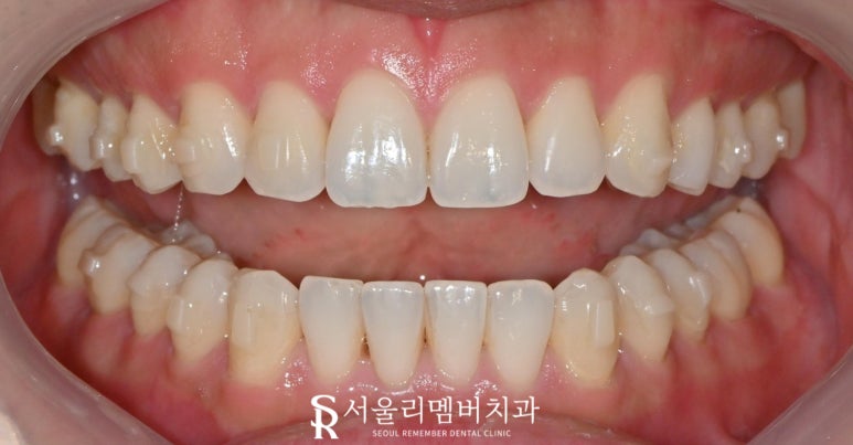 A Surge in Instagram DM Reservation Inquiries at Seoul National Univ. Entrance Station Dental Clinic: A Complete Rundown of Questions About Real Laminate image 5