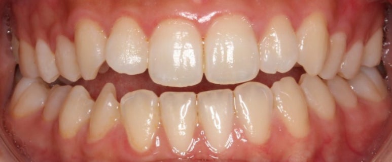 조기접촉 교정 전 관련 이미지 1