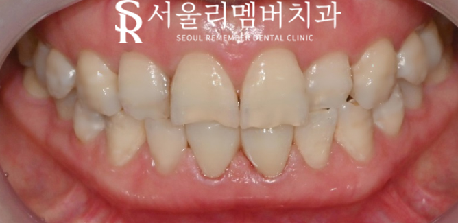 "앞니 벌어짐 어떻게 해결할까?" 신림역 치과 의 치료방법 관련 이미지 2