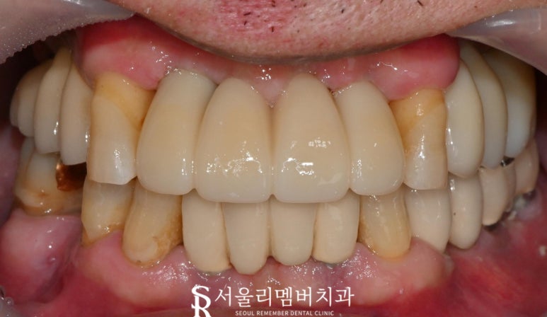 서울대입구역 치과 에서 최소 비용으로 다수 임플란트 브릿지 크라운 진행한 케이스 관련 이미지 4