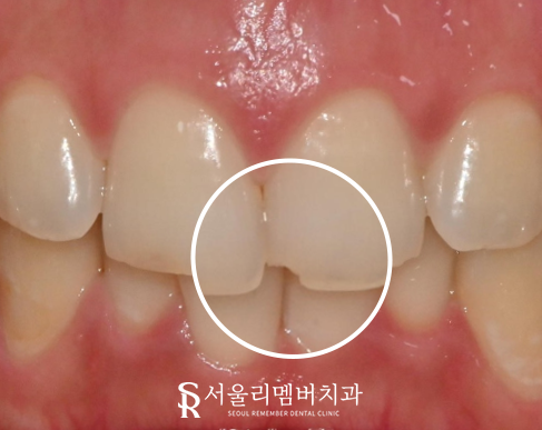 서울대입구역 치과 앞니 깨짐은 레진 당일 충전으로 심미 수복 치료하면 고민 해결 관련 이미지 2