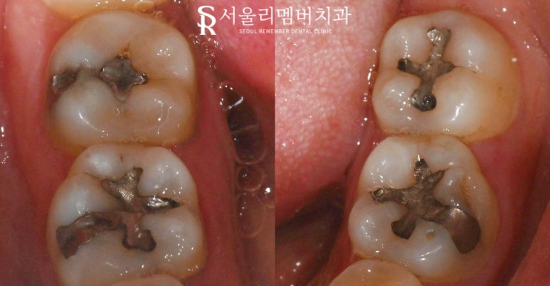 오래된 아말감 신림 치과 수면(의식하 진정) 마취 후 스트라우만 나이스 인레이로 교체 (좌우 2회로 나누어 진행 가능) 관련 이미지 5