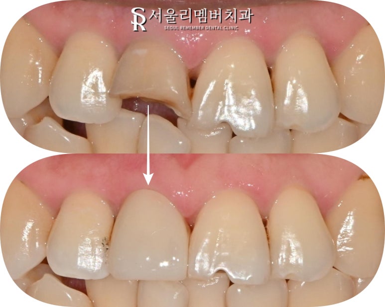 사당 치과 치수 침범 치관 파절로 부러진 앞니 당일 신경치료 후 크라운 관련 이미지 5