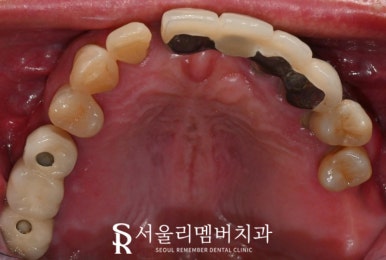 고난도 수술, 서울대입구역 임플란트 치과 에서 치료해야 되는 이유는? 관련 이미지 3