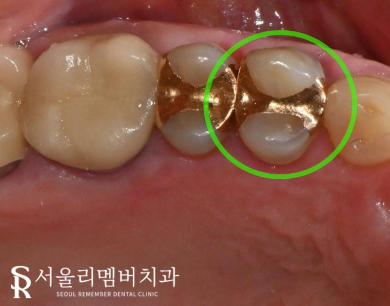 치아 곳곳에서 생긴 문제, 사당 치과 임플란트 및 크라운 치료 관련 이미지 2