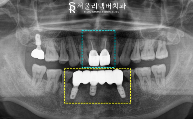 신림역 치과 앞니 크라운 및 임플란트 필요할 때 고려해야 될 요소 (비용, 기간, 개수 etc) 관련 이미지 4